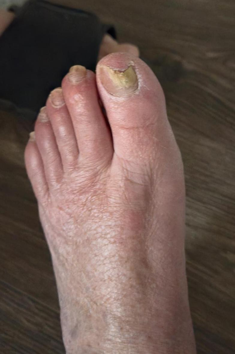 kalknagels die afbrokkelen